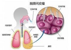 石棉瓦致癌，家中的石棉瓦必要裁撤吗？